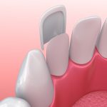 Closeup of a mouth with permanent dental veneers bonded to the front of the teeth