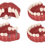 Cartoon configurations of dental bridges to replace a missing tooth in Denver, CO
