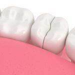 A cracked tooth that needs to be repaired at the dentist in Denver, CO